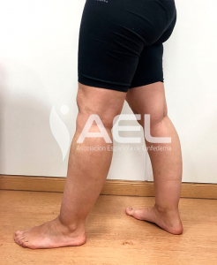 Lipedema